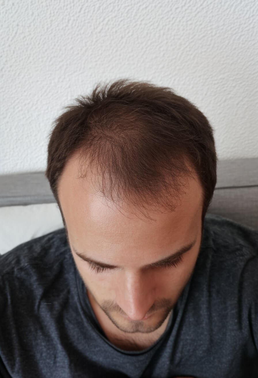 Hair of Ahmed M. before PRP treatment with supplements
