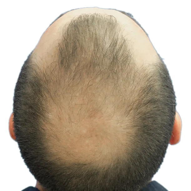Vorher: Haartransplantation FUE, 4.900 Grafts, Hinterkopf 1