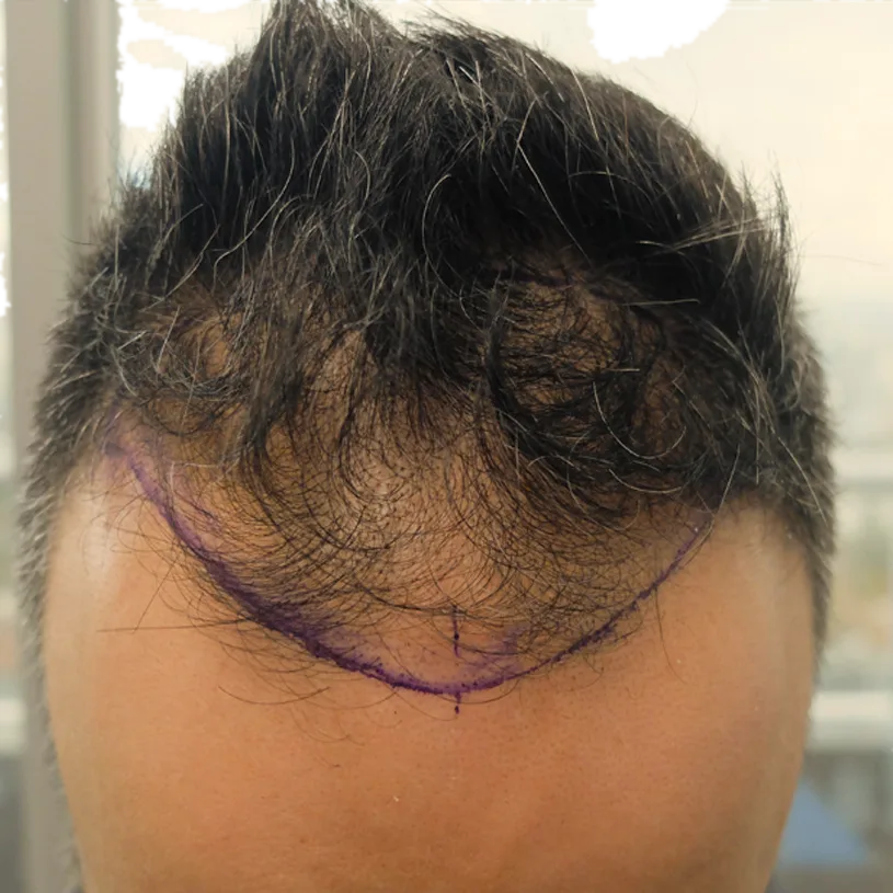 Vorher: Haartransplantation FUE, 3.100 Grafts, Haarlinie
