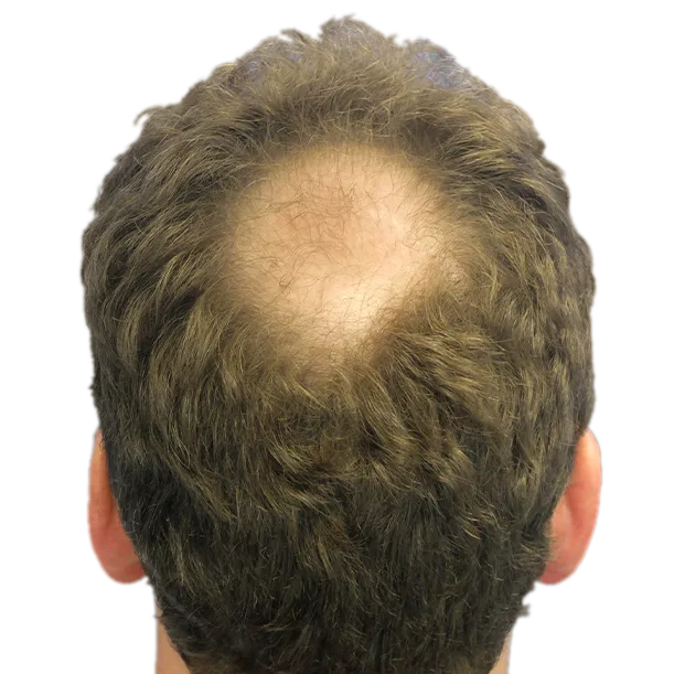 Vorher: Haartransplantation FUE, 3.000 Grafts, Hinterkopf