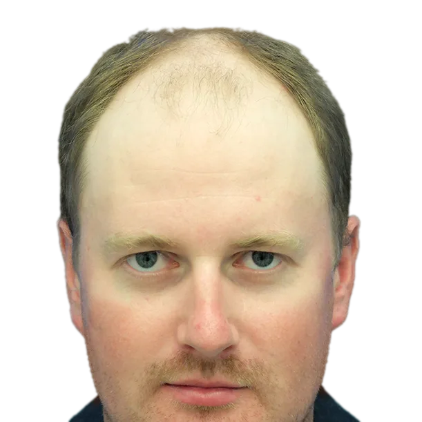 Vorher: Haartransplantation FUE, 6.000 Grafts, Front