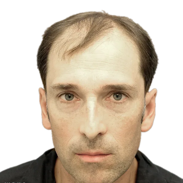 Vorher: Haartransplantation FUT, 6.500 Grafts, Front 2