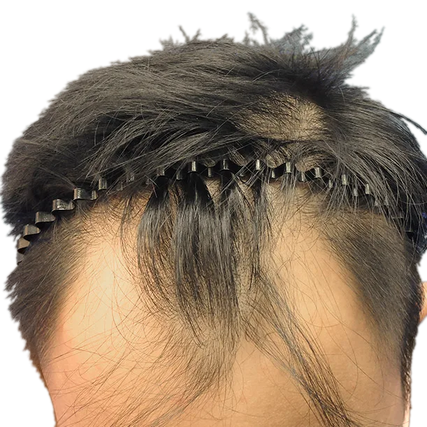 Vorher: Haartransplantation FUE, 2.200 Grafts, Oberkopf