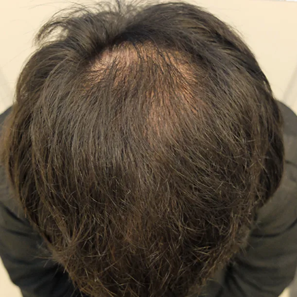 15 Monate: Haartransplantation FUE, 4.400 Grafts, Hinterkopf