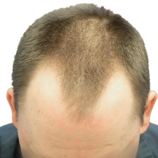 Vorher: Haartransplantation FUE, 3.100 Grafts, Oberkopf