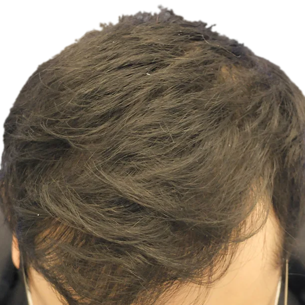 10 Monate: Haartransplantation FUE, 3.900 Grafts, Oberkopf