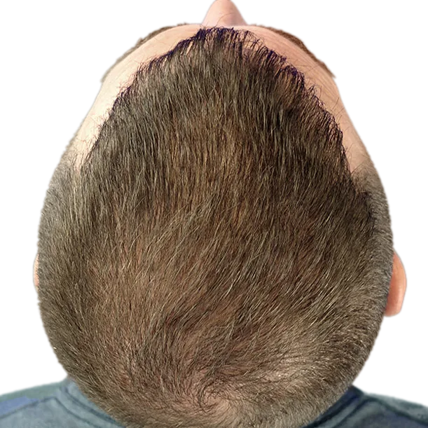 12 Monate: Haartransplantation FUE, 4.900 Grafts, Hinterkopf 1