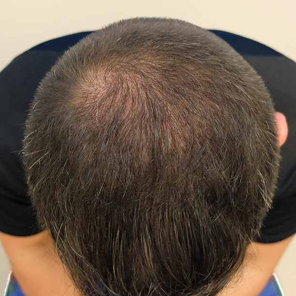 Nachher: Haartransplantation FUE, 2.400 Grafts, Oberkopf