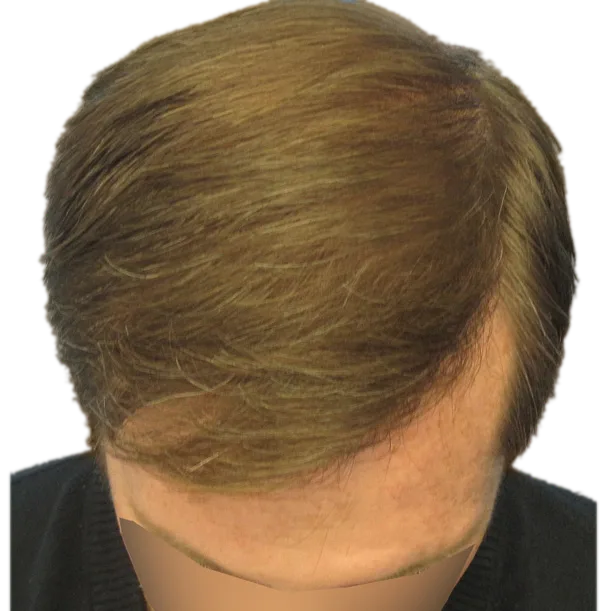 Nachher: Haartransplantation FUT, 5.500 Grafts, Oberkopf