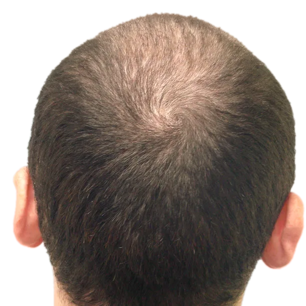 Vorher: Haartransplantation FUT, 5.800 Grafts, Hinterkopf