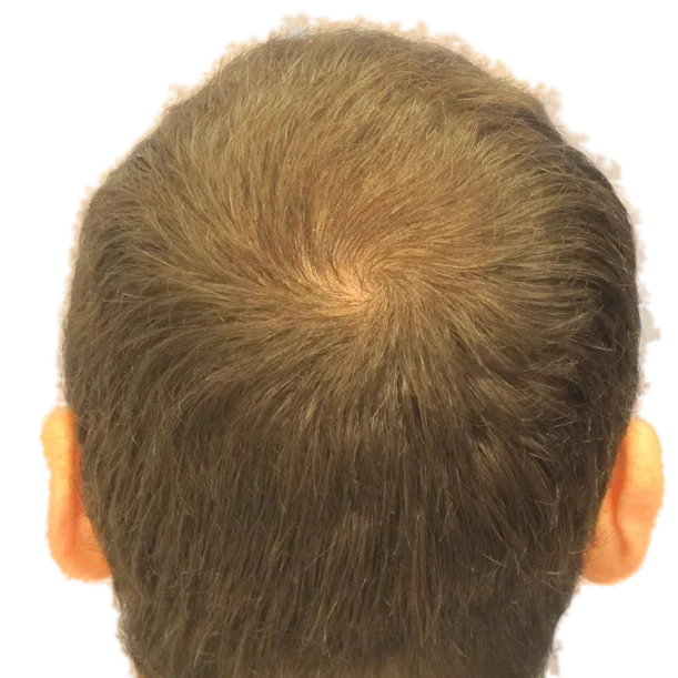 Nachher: Haartransplantation FUT, 5.800 Grafts, Hinterkopf
