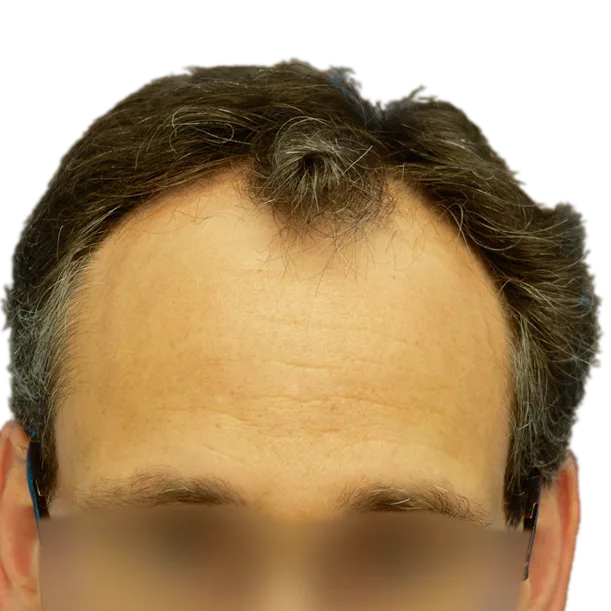 Vorher: Haartransplantation FUT, 4.700 Grafts, Haarlinie