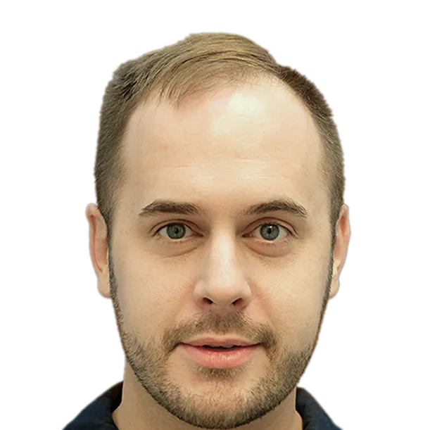 Vorher: Haartransplantation FUE, 3.700 Grafts, Front