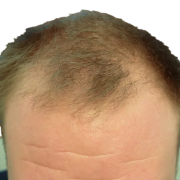 Vorher: Haartransplantation FUT, 8.300 Grafts, Haarlinie