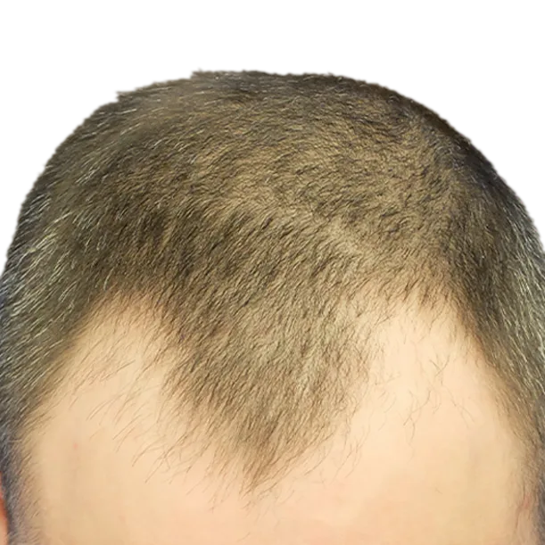 Vorher: Haartransplantation FUE, 3.100 Grafts, Oberkopf