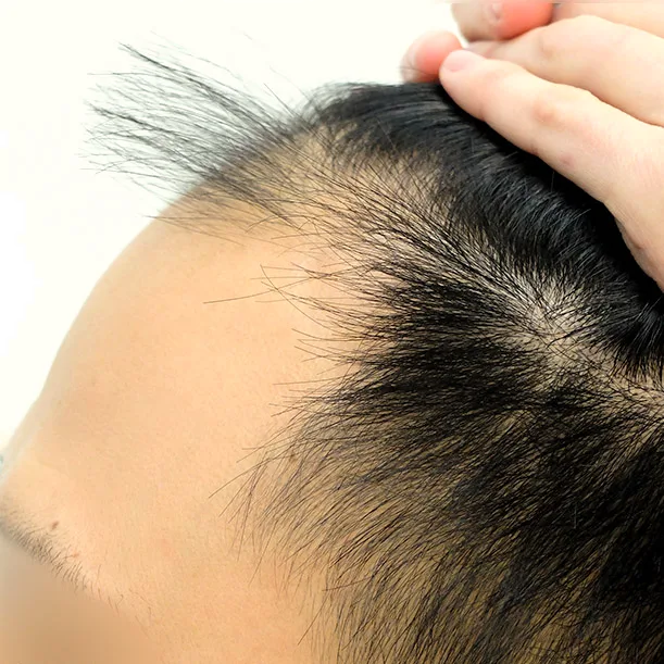 Vorher: Haartransplantation FUE, 2.600 Grafts, Profil 1