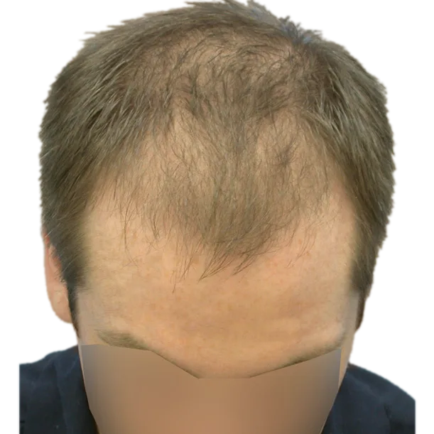 Vorher: Haartransplantation FUT, 5.500 Grafts, Oberkopf