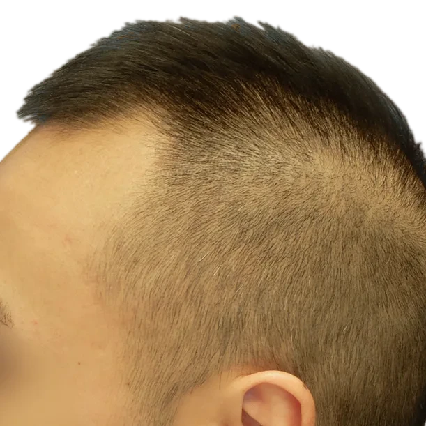 Vorher: Haartransplantation FUE, 2.300 Grafts, Ansicht 3