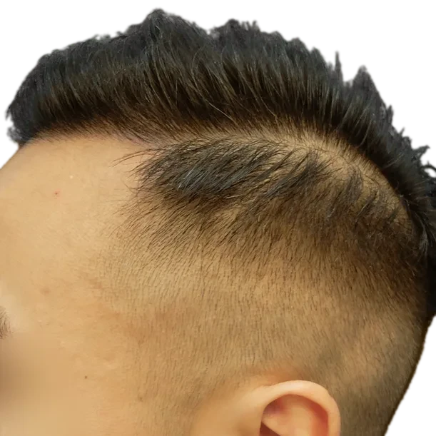 Nachher: Haartransplantation FUE, 2.300 Grafts, Ansicht 3