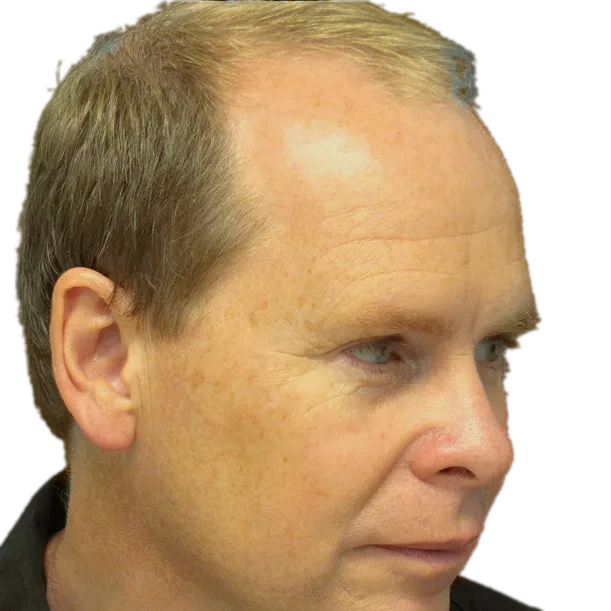 Vorher: Haartransplantation FUT, 7.100 Grafts, Seite 1