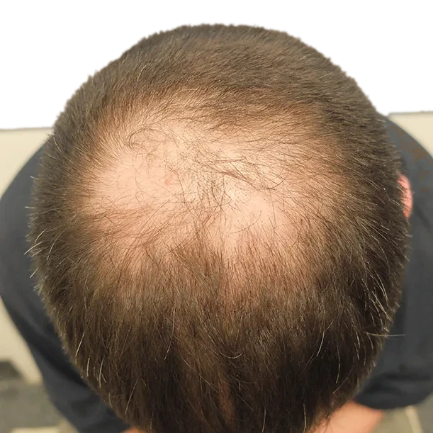 Vorher: Haartransplantation FUE, 2.400 Grafts, Oberkopf