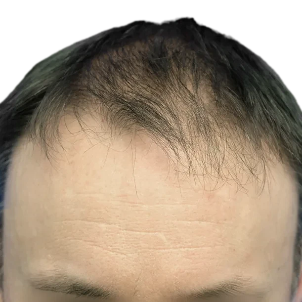 Vorher: Haartransplantation FUE, 4.300 Grafts, Oberkopf 2