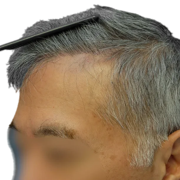 Nachher: Haartransplantation FUT, 2.900 Grafts, Seite 1