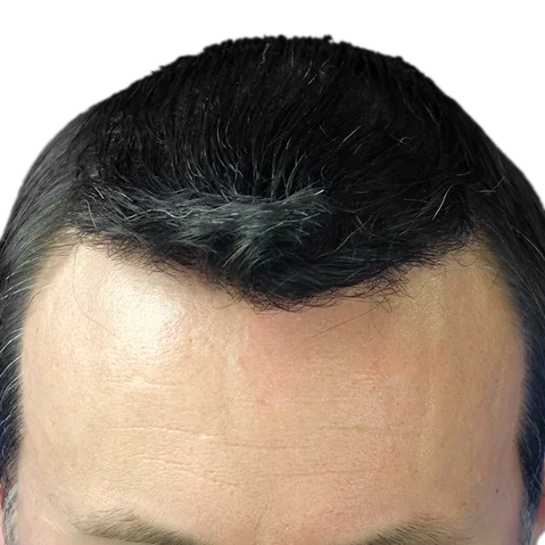Nachher: Haartransplantation FUE, 4.300 Grafts, Oberkopf 2