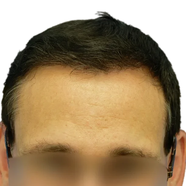 Nachher: Haartransplantation FUT, 4.700 Grafts, Haarlinie