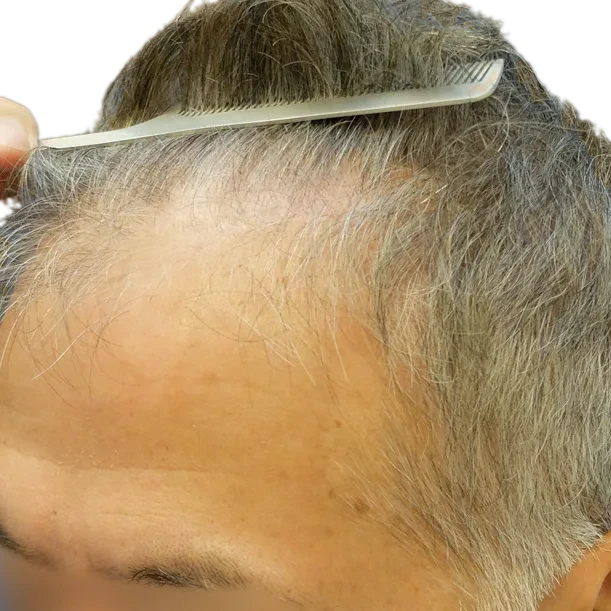 Vorher: Haartransplantation FUT, 2.900 Grafts, Seite 1