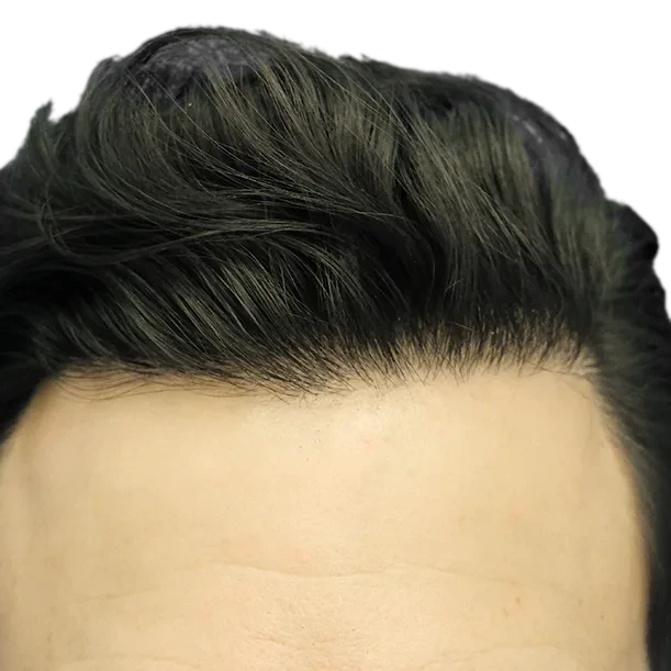 24 Monate: Haartransplantation FUE, 4.500 Grafts, Haarlinie