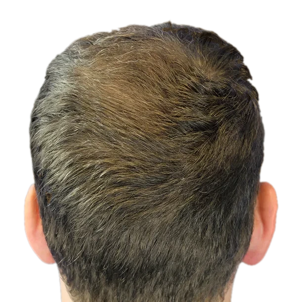 6 Monate: Haartransplantation FUE, 3.000 Grafts, Hinterkopf