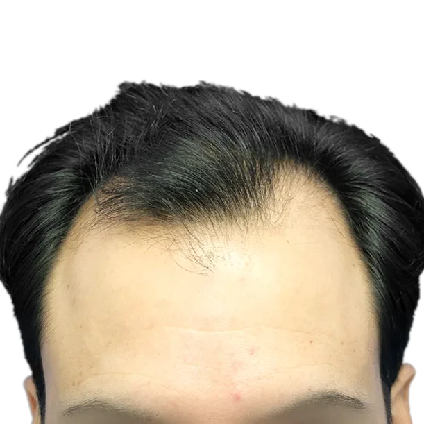 Vorher: Haartransplantation FUE, 4.500 Grafts, Haarlinie