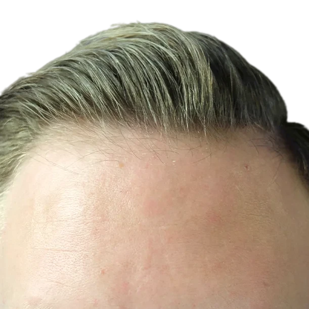 Nachher: Haartransplantation FUT, 8.300 Grafts, Haarlinie