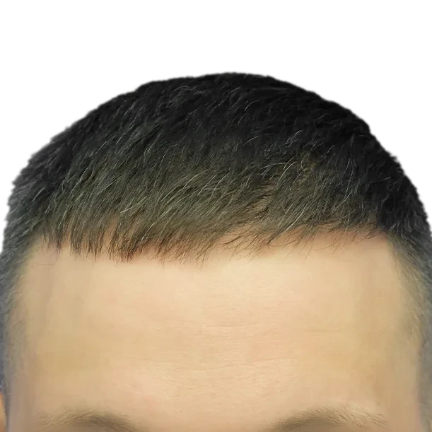 Nachher: Haartransplantation FUE, 3.100 Grafts, Oberkopf