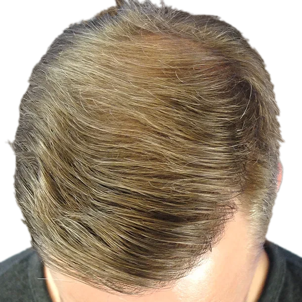 12 Monate: Haartransplantation FUE, 4.900 Grafts, Oberkopf 1