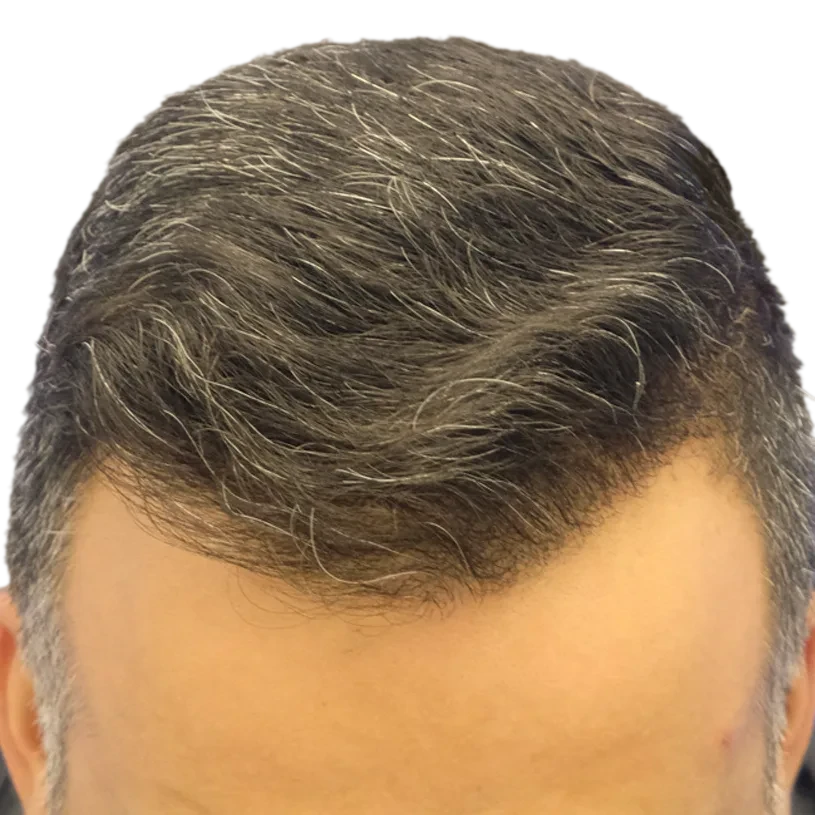 7 Monate: Haartransplantation FUE, 3.100 Grafts, Haarlinie