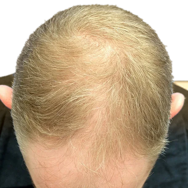 Vorher: Haartransplantation FUE, 4.900 Grafts, Oberkopf 1