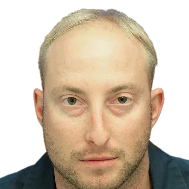 Vorher: Haartransplantation FUE, 4.200 Grafts, Front