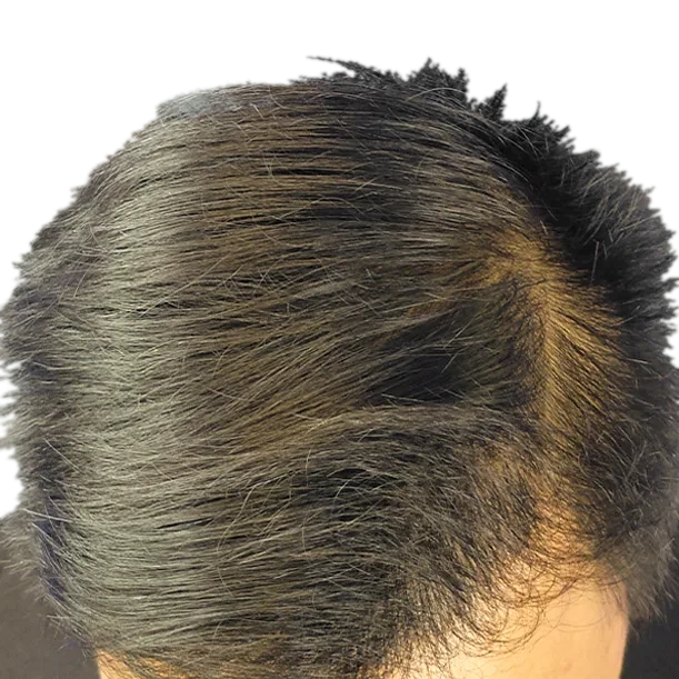 7 Monate: Haartransplantation FUE, 2.200 Grafts, Oberkopf