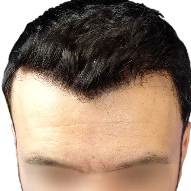 9 Monate: Haartransplantation FUE, 3.400 Grafts, Oberkopf