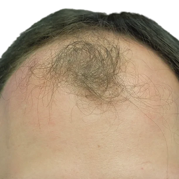 Vorher: Haartransplantation FUE, 4.500 Grafts, Haarlinie