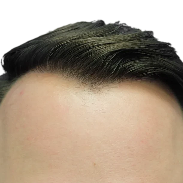 36 Monate: Haartransplantation FUE, 4.500 Grafts, Haarlinie