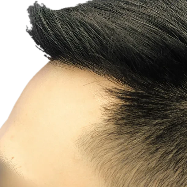 12 Monate: Haartransplantation FUE, 2.600 Grafts, Profil 1