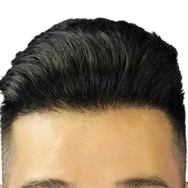 12 Monate: Haartransplantation FUE, 3.500 Grafts, Haarlinie