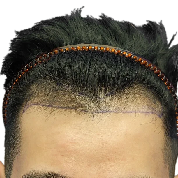 Vorher: Haartransplantation FUE, 3.500 Grafts, Haarlinie