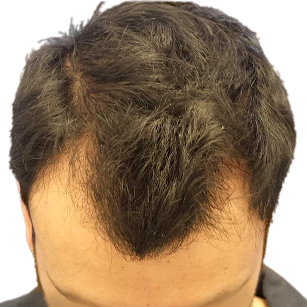 Vorher: Haartransplantation FUE, 3.400 Grafts, Oberkopf