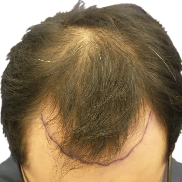 Vorher: Haartransplantation FUE, 3.900 Grafts, Oberkopf