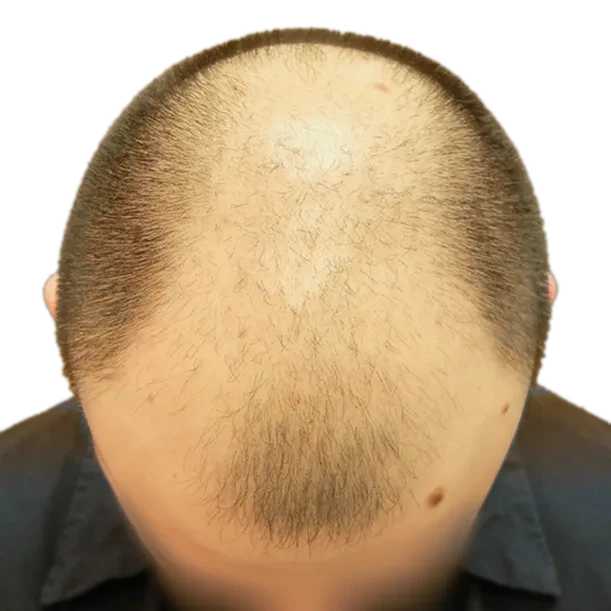 Vorher: Haartransplantation FUE, 4.400 Grafts, Hinterkopf
