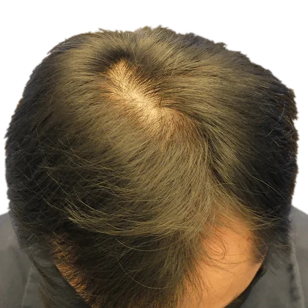 Vorher: Haartransplantation FUE, 1.600 Grafts, Oberkopf